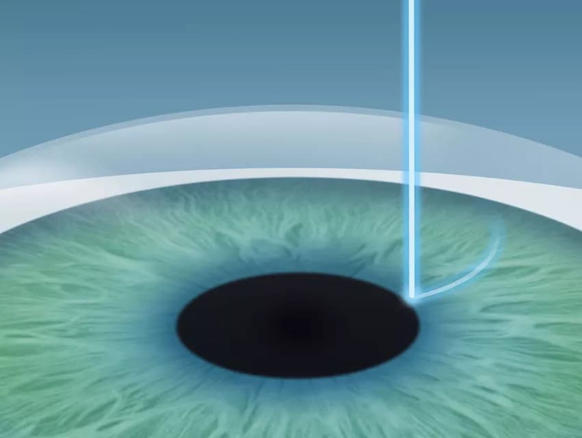 Femtosecond laser creating a corneal flap during Femto-LASIK