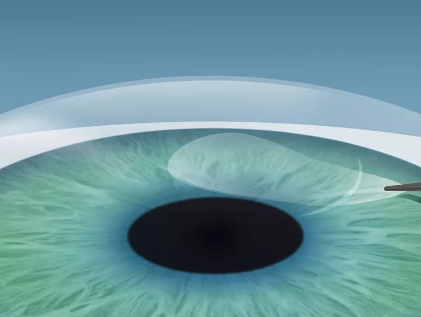 Excimer laser reshaping the cornea during Femto-LASIK